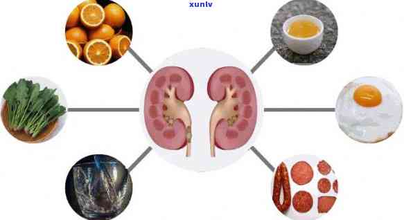 茶喝多了得肾结石吗？女性该如何预防和治疗？