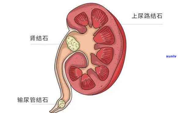 喝茶过多会导致肾结石吗？影响肾结石发作和加重的风险是什么？