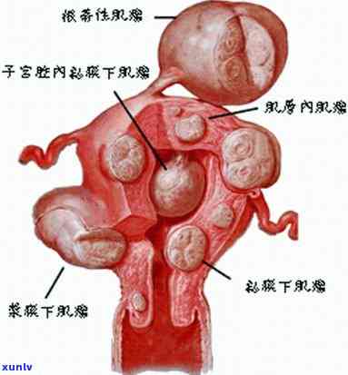 女人长期吃紫的好处：揭秘其对子宫肌瘤的影响与风险