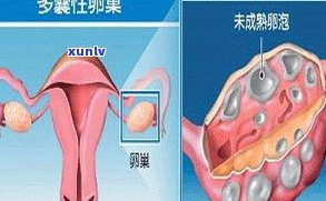 多囊卵综合症患者能喝去湿茶吗？