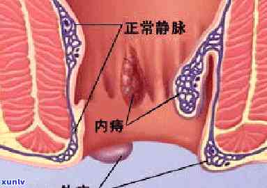 美团金融信用卡逾期怎么办如何处理？