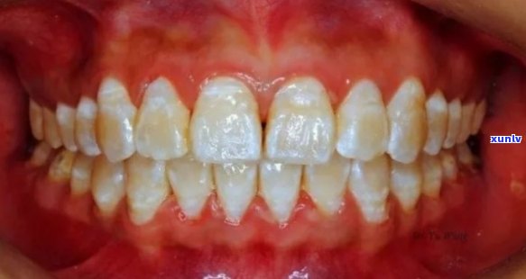 喝马黛茶牙变颜色了正常吗？了解可能导致牙齿变色的原因与解决方案