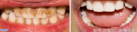 喝马黛茶牙变颜色了正常吗？了解可能导致牙齿变色的原因与解决方案