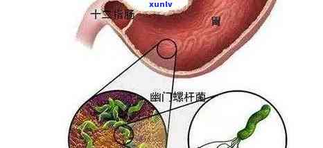 红茶能否杀死幽门螺杆菌？效果如何？可以饮用吗？——知乎探讨