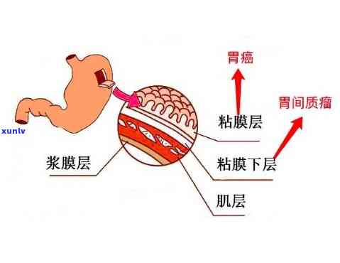 茶里什么成分 *** 胃黏膜，揭秘：茶中的哪些成分可能 *** 胃黏膜？