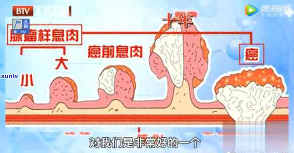 肠道息肉喝什么茶好？专家推荐有效饮品，加速恢复！