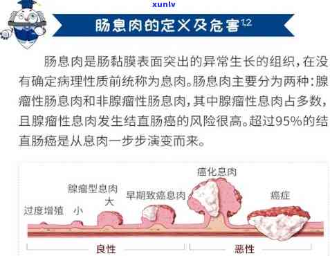 肠息肉代茶饮方，肠息肉代茶饮方：养生良药，助你远离疾病