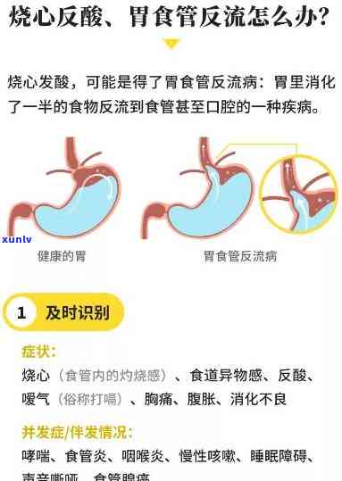 喝完茶想吐反酸怎么办？快速缓解 *** 大揭秘！