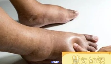 腿肿喝什么消肿？效果好、快速的 *** 全在这！