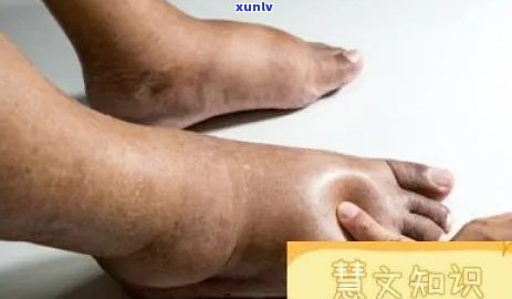 腿肿喝什么茶效果好-腿肿喝什么茶效果好一点