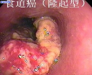 食道烂食疗： *** 与食物推荐