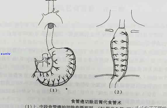 食道烂食疗： *** 与食物推荐