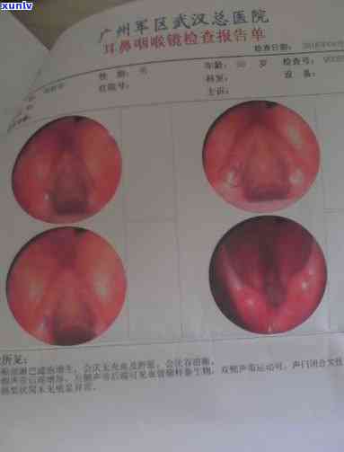 声带炎喝什么药？如何选择合适的消炎药？