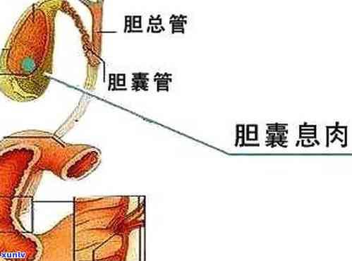 胆囊息肉喝什么茶可以消除，喝茶也能消胆囊息肉？这些茶或能帮到你！