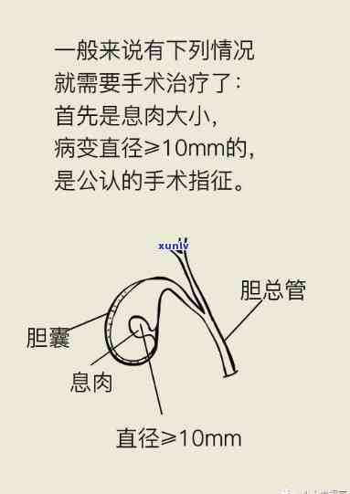 公英除息肉很害：胆囊问题的天然解决方案