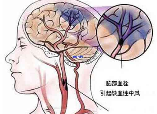 脑血栓适合喝哪类茶水，脑血栓患者应选择哪种茶水？