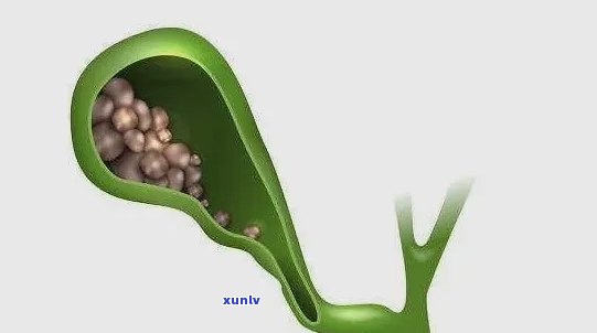 胆囊结石喝什么茶？哪种茶能有效帮助排出结石？