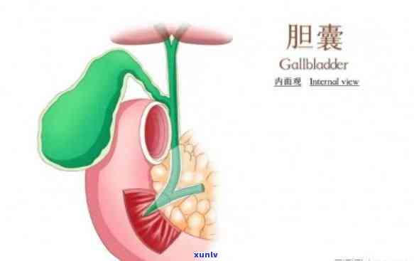 胆囊结石的人喝什么喝哪一种茶，解密：胆囊结石患者适合饮用哪种茶叶？