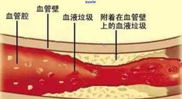 常喝哪些茶能清理血管？从垃圾到塞全面解析