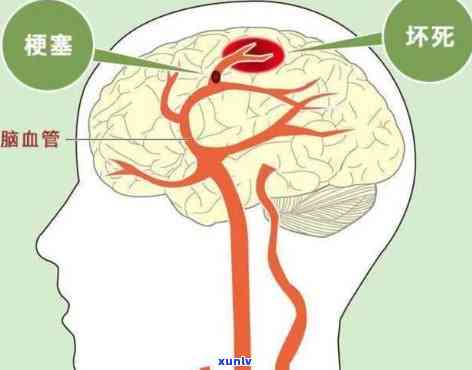 预防脑梗喝什么茶好-预防脑梗和血管塞喝什么茶