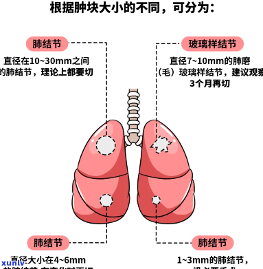 肺结节的克星，揭秘肺结节的