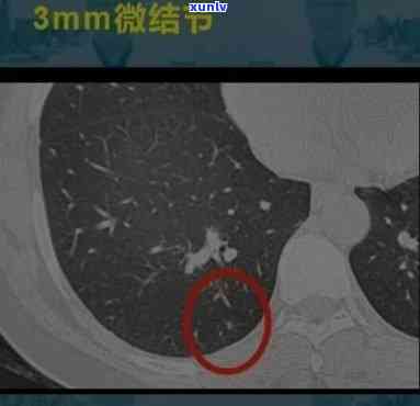 磨玻璃结节喝什么茶好？快速缓解的 *** 与适宜运动推荐