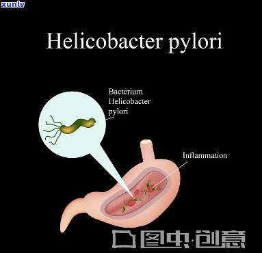 什么茶治疗幽门螺旋杆菌？求推荐有效饮品