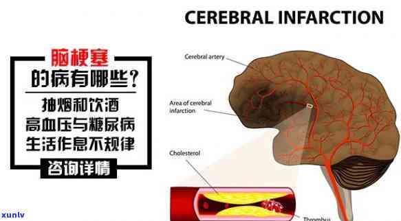 脑梗患者喝什么茶好？医生推荐的三大饮品，赶快试试！