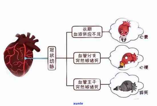 脑梗心梗喝什么茶好？专业解答帮你选！