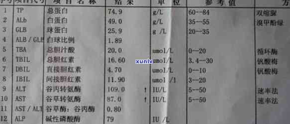 转氨酶偏高可以喝红牛吗，转氨酶偏高的人是否适合饮用红牛？