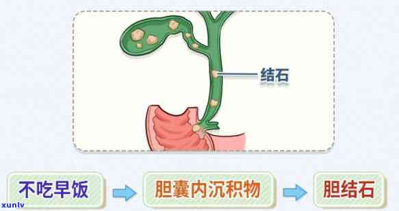 胆结石不能和什么茶一起吃？禁忌与推荐全解析