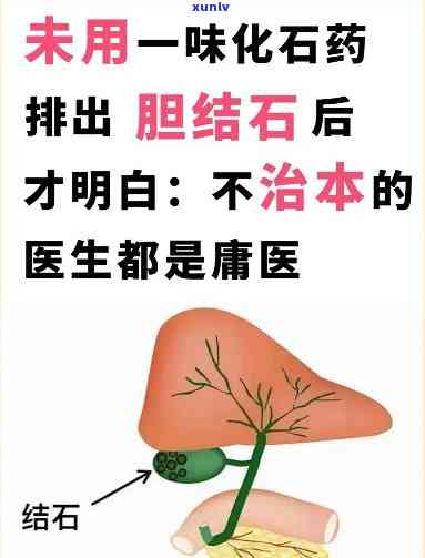 胆结石不能和什么茶一起吃？禁忌与推荐全解析