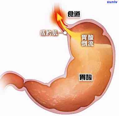 经常胃酸适合喝什么茶，常感胃酸？这些茶或能帮到你！