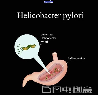 什么茶治幽门螺杆菌-喝什么茶可以治疗幽门螺杆菌