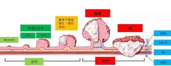 怎么预防肠不再长息肉？清凉的茶是否能帮助？哪种茶最适合预防肠息肉？试试这款代茶饮！