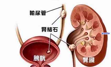 肾结石喝什么茶水效果，肾结石患者的福音：哪种茶水对缓解症状最有效？