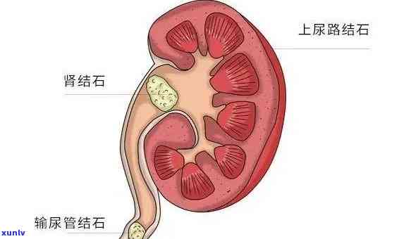 肾结石喝什么茶水效果，肾结石患者的福音：哪种茶水对缓解症状最有效？