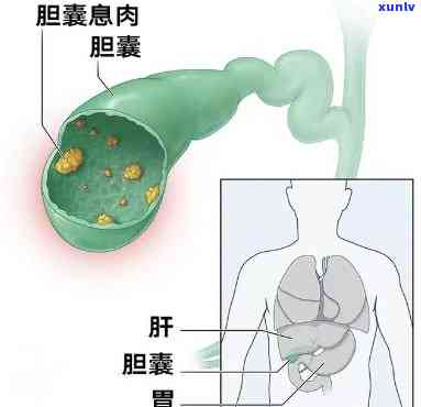 什么茶对胆囊息肉好？针对此病，哪种茶最有效？