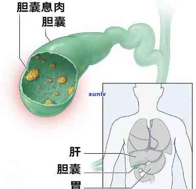 什么茶对胆囊息肉好一点？效果、类型及饮用建议全解析