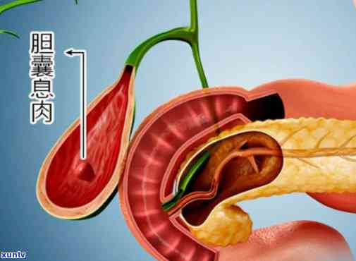 什么茶对胆囊息肉好一点？效果、类型及饮用建议全解析