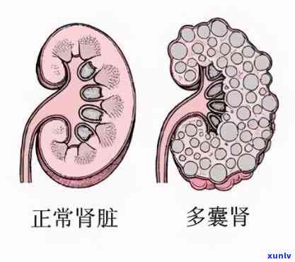 什么样的人易得肾囊肿？女性肾囊肿能否自愈？囊肿正常大小是多少？