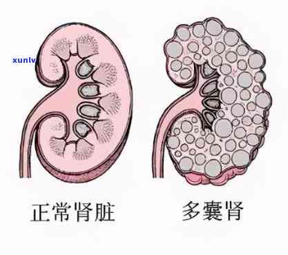 什么茶对肾囊肿-什么样的人容易得肾囊肿