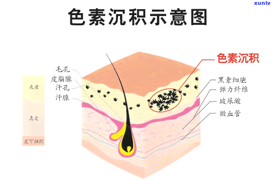 喝什么茶淡化黑色素-喝什么茶淡化黑色素沉着