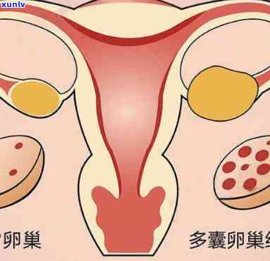 多囊卵可以喝茶吗-多囊卵可以喝茶吗,对身体有没有危害