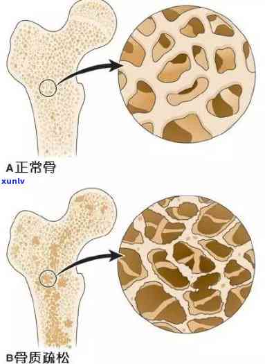 骨质疏松不能喝茶吗知乎，骨质疏松患者是否适合喝茶？知乎上有什么观点？