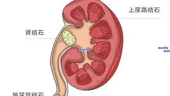 男人肾结石能喝茶吗-男人肾结石能喝茶吗