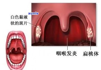 喉咙发炎能喝茶水吗？大人可以喝吗？多少合适？