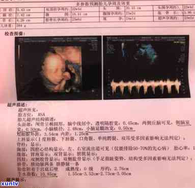 孕晚期可以喝茶水吗？羊水少，四维显示可能为女孩