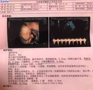 孕晚期可以喝茶水吗？羊水少，四维显示可能为女孩