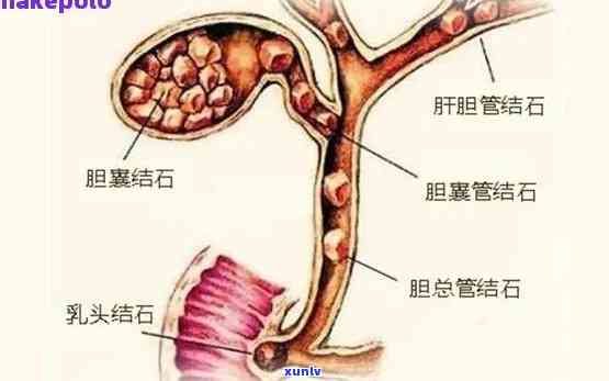 胆管结石能否喝茶？影响因素是什么？